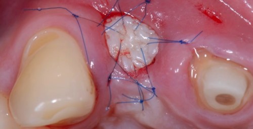 Available techniques for soft tissue grafting 